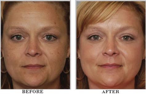 BBL Surgery: Real Deal From Women Who've Gotten It.